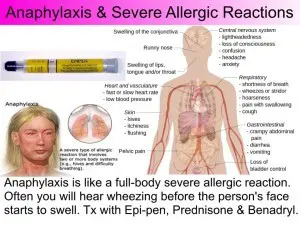 anaphylaxis